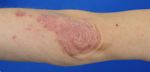Vortrag Die Schuppenflechte (Psoriasis) – Von der Hauterkrankung zum Herzinfarkt